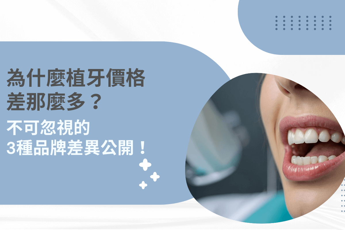 植牙價格差異品牌比較圖，揭露三種品牌價差原因