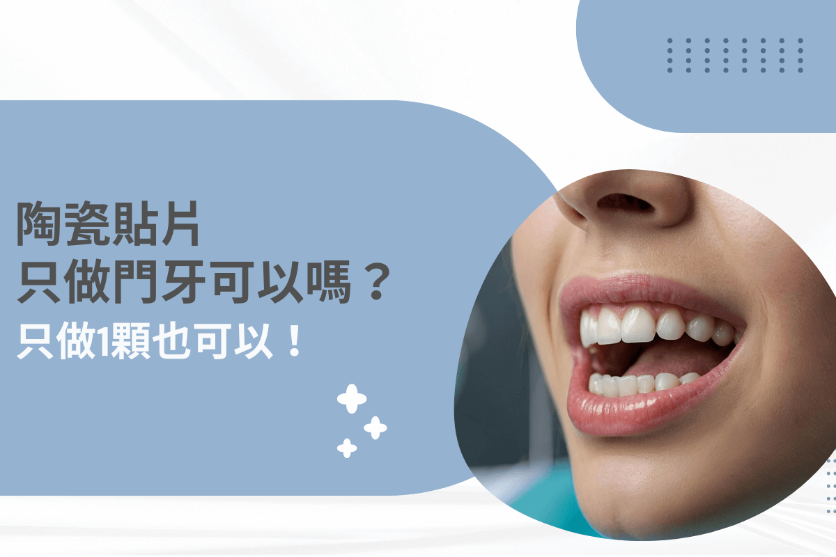 陶瓷貼片只做門牙可以嗎封面圖