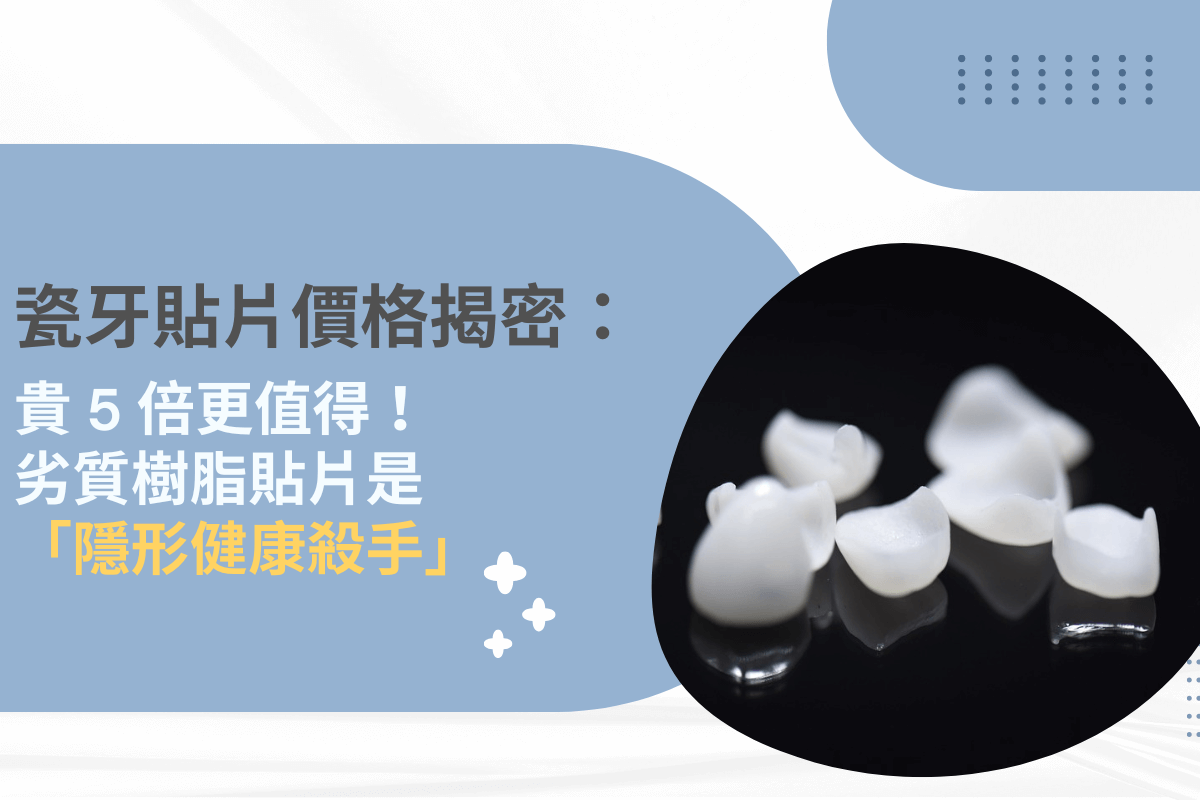 瓷牙貼片價格揭密：劣質樹脂貼片是「隱形健康殺手」
