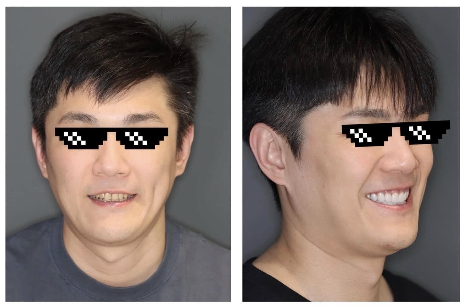 美學牙醫重塑笑容前後對比：提升自信與臉部協調性