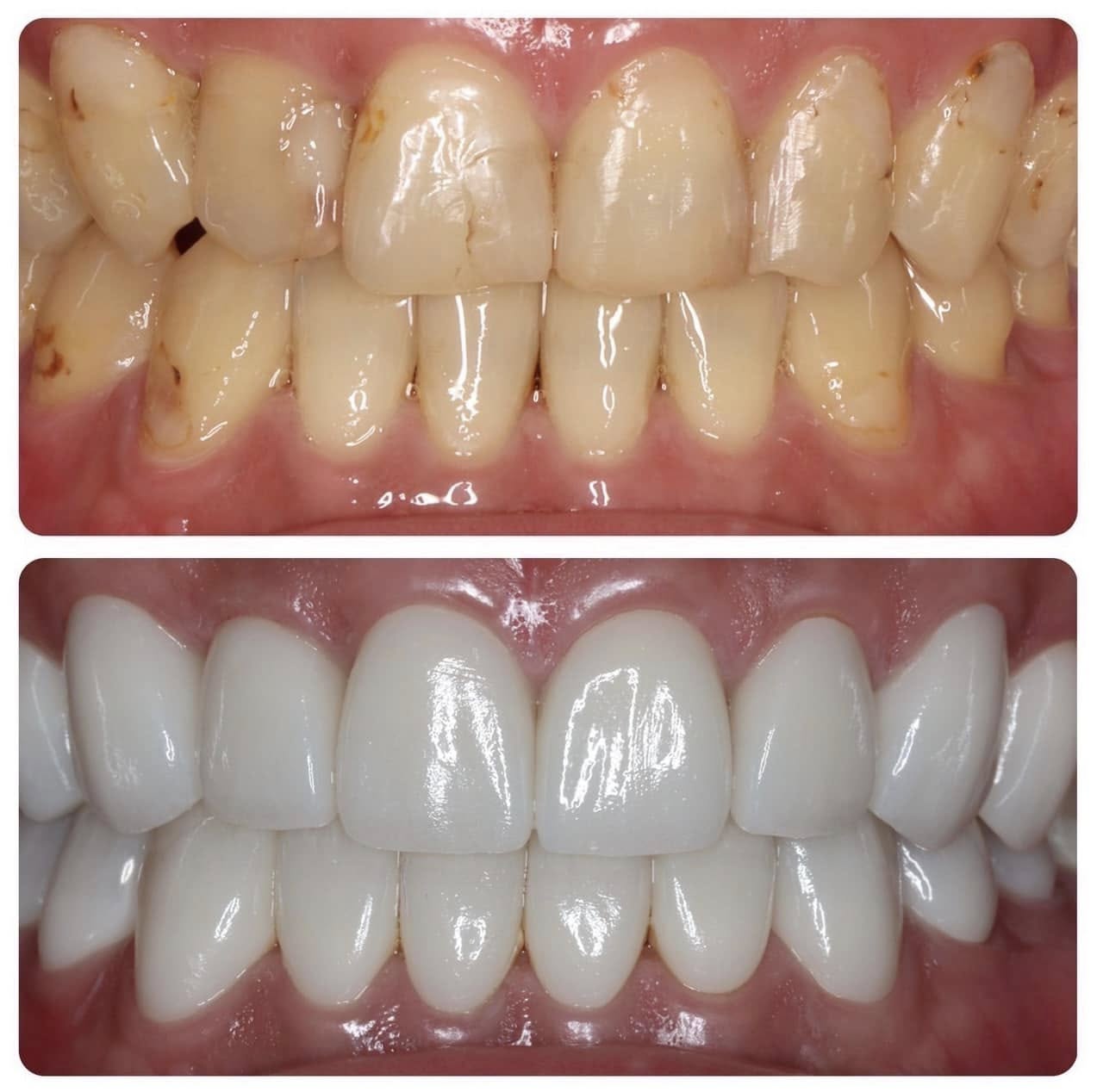 全瓷冠/陶瓷貼片治療前後對比：從損壞到完美微笑