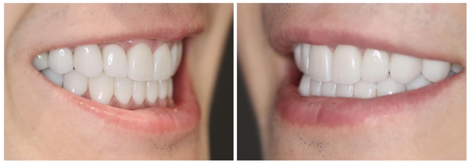 美學牙科治療成果：側面微笑特寫展示自然牙齒曲線