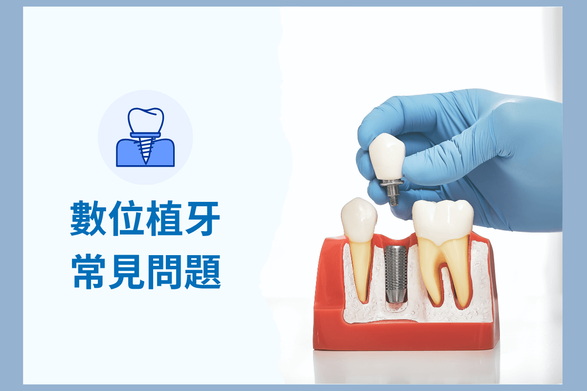 數位植牙常見問題：流程、優勢、費用與風險全解析