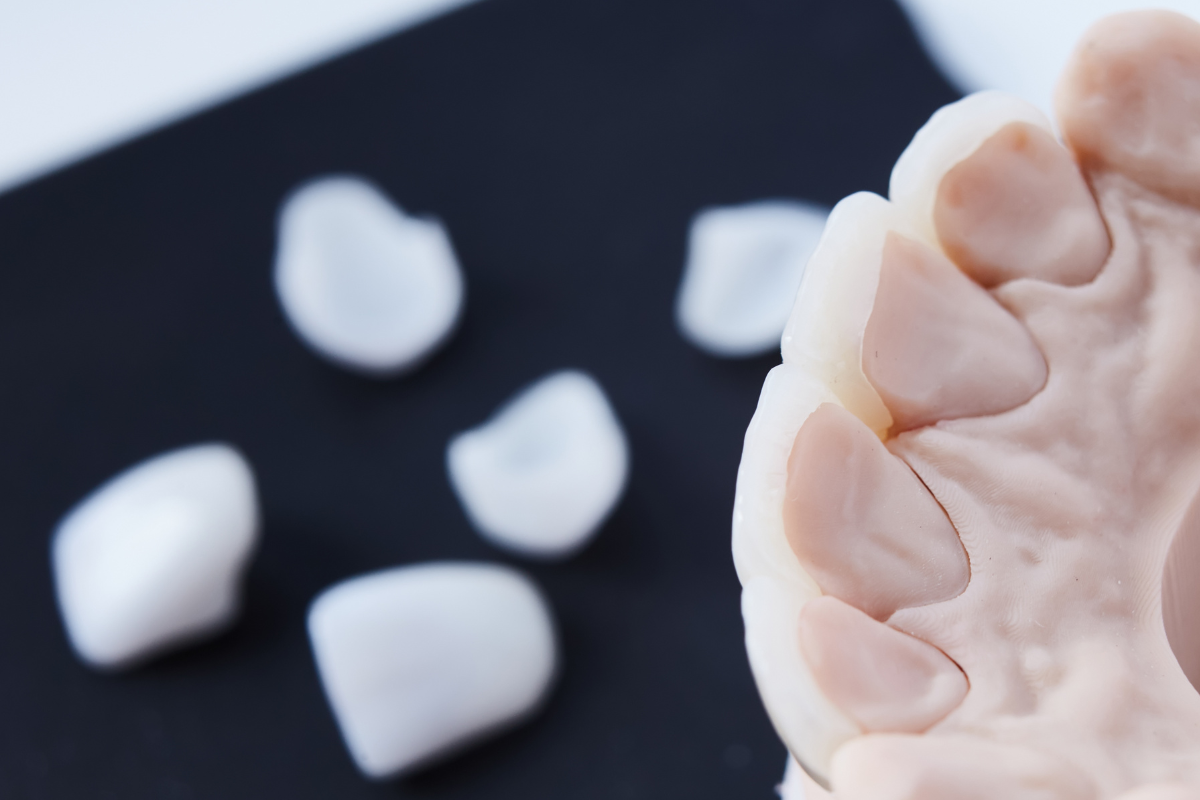 微創美學：高仿真陶瓷貼片與牙齒模型細節