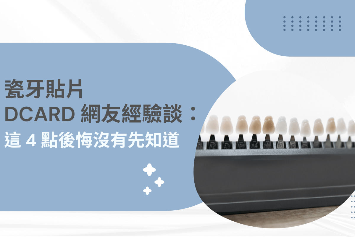 瓷牙貼片 DCARD 網友經驗談：這 4 點後悔沒有先知道