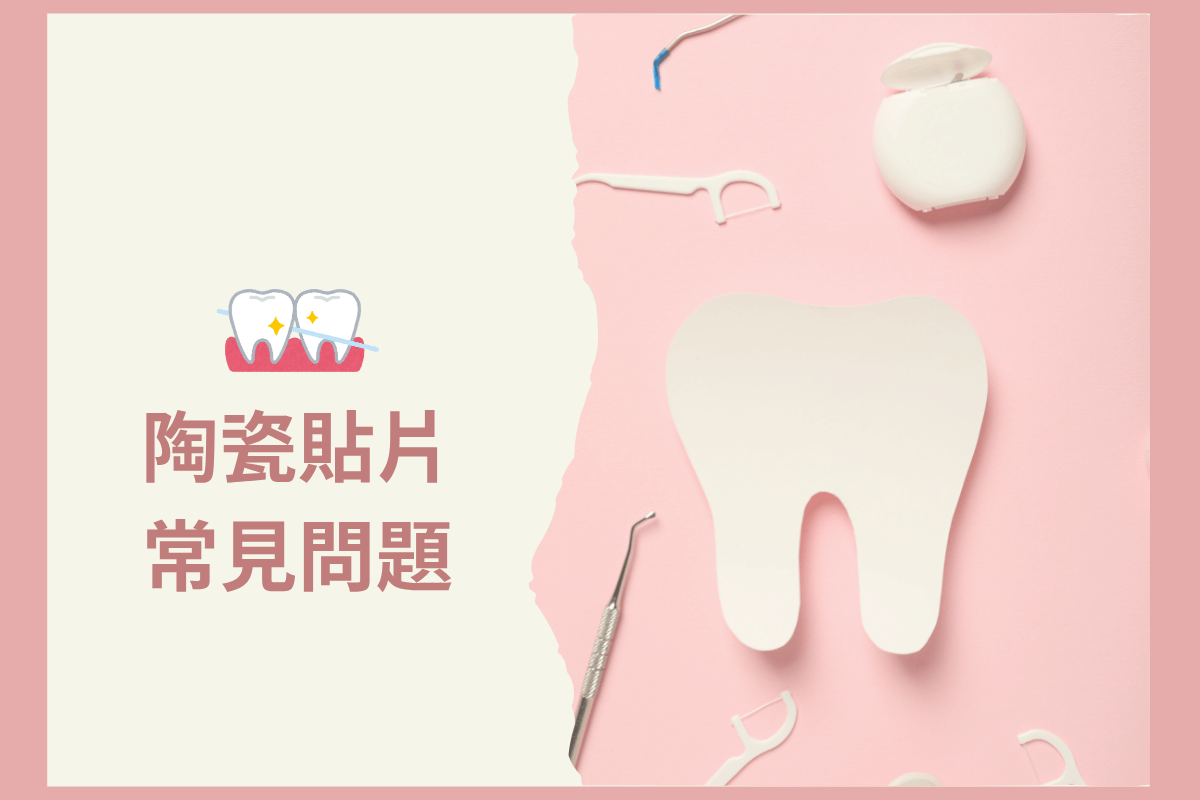 陶瓷貼片常見問題：費用、壽命、保養方式一次看