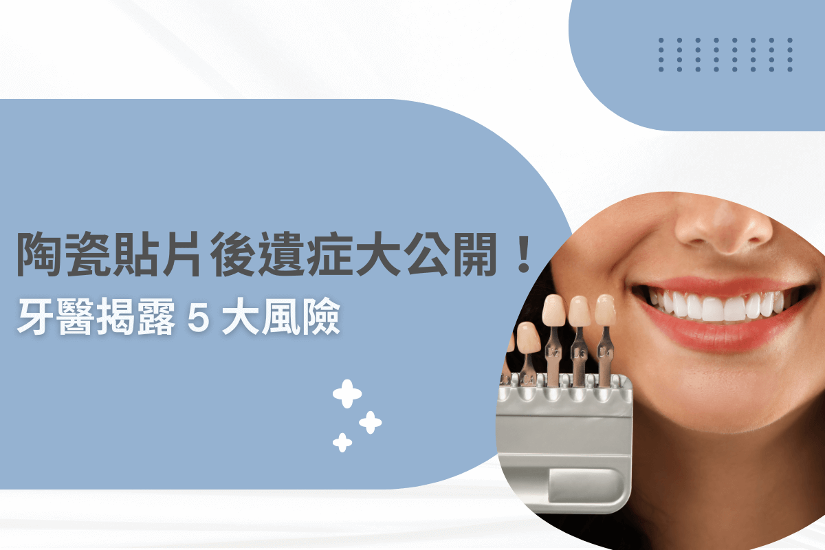 陶瓷貼片後遺症大公開！牙醫揭露 5 大風險