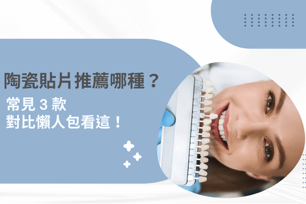 陶瓷貼片推薦哪種？常見 3 款對比懶人包看這！