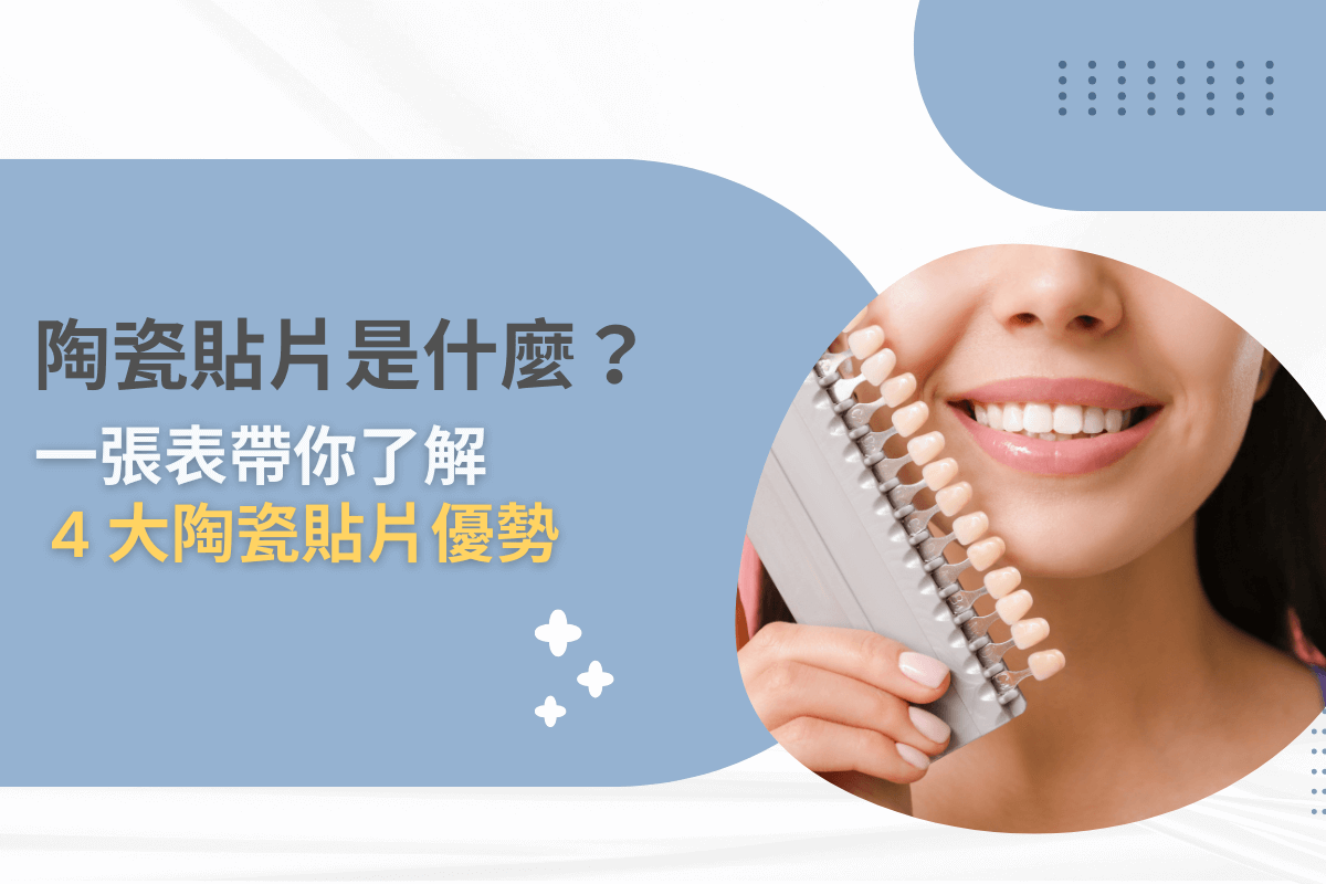 陶瓷貼片是什麼？一張表帶你了解 4 大陶瓷貼片優勢