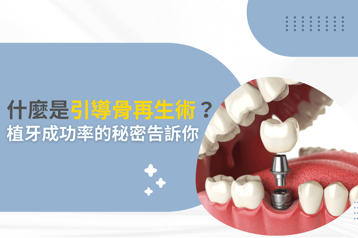 什麼是引導骨再生術？植牙成功率的秘密告訴你