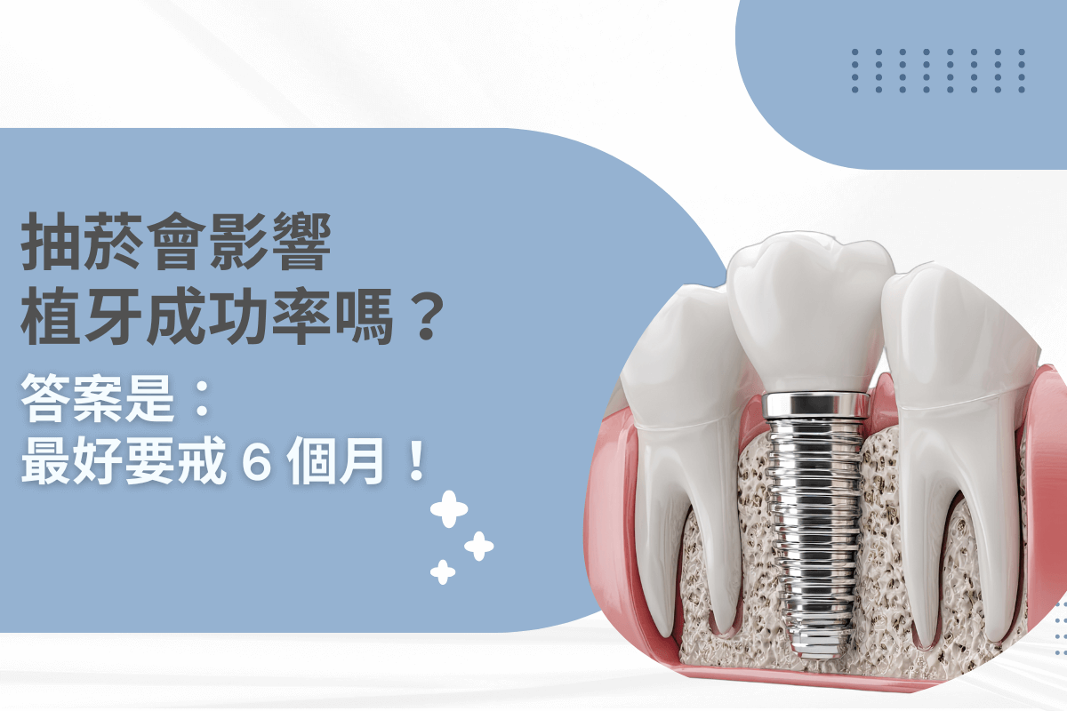 抽菸會影響植牙嗎？專業牙醫建議：術前術後戒菸 6 個月是關鍵