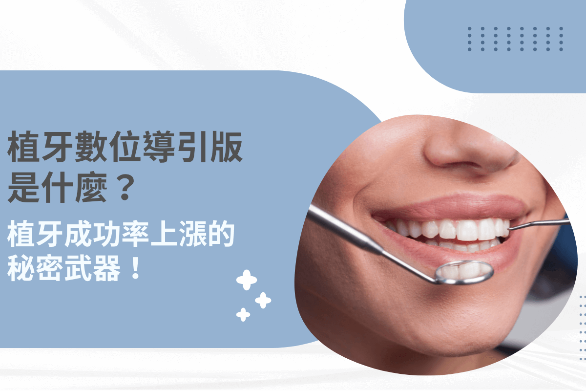 植牙數位導引板是什麼？植牙成功率上漲的秘密武器！