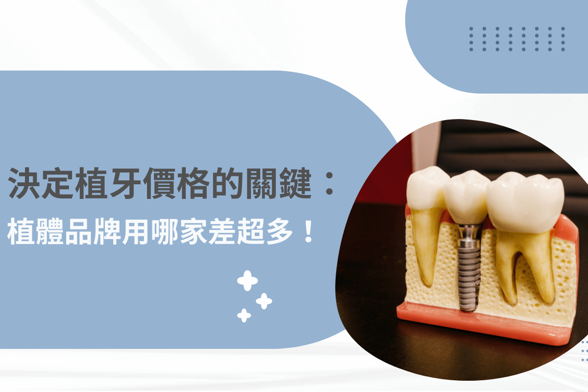 決定植牙價格的關鍵：植體品牌用哪家差超多！