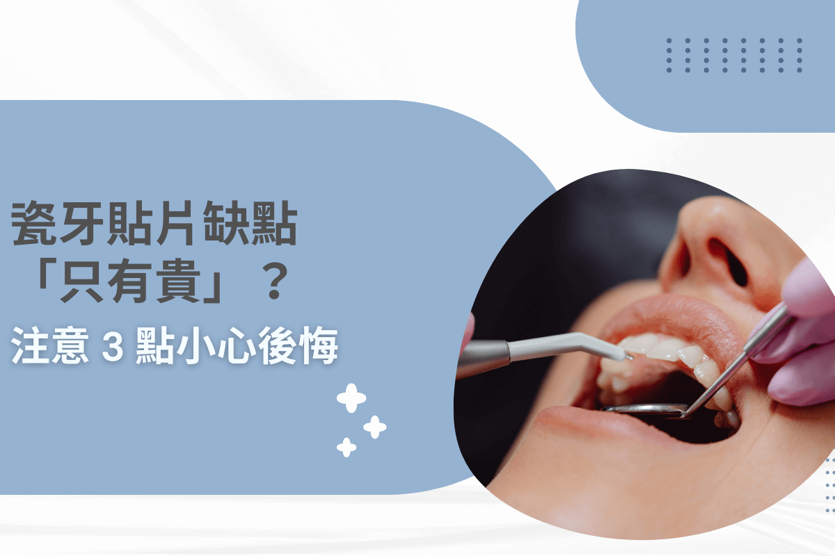瓷牙貼片缺點「只有貴」？注意 3 點小心後悔