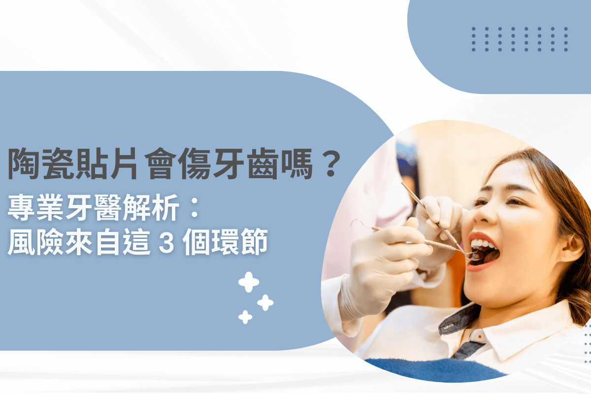 陶瓷貼片會傷牙齒嗎？專業牙醫解析：風險來自這 3 個環節