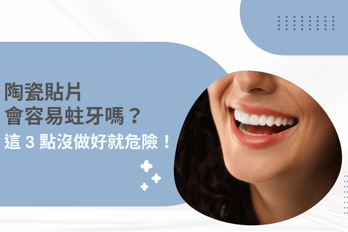 陶瓷貼片會容易蛀牙嗎？這 3 點沒做好就危險！