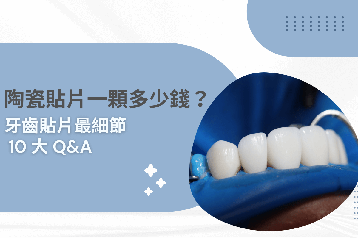 陶瓷貼片一顆多少錢？牙齒貼片最細節 10 大 Q&A