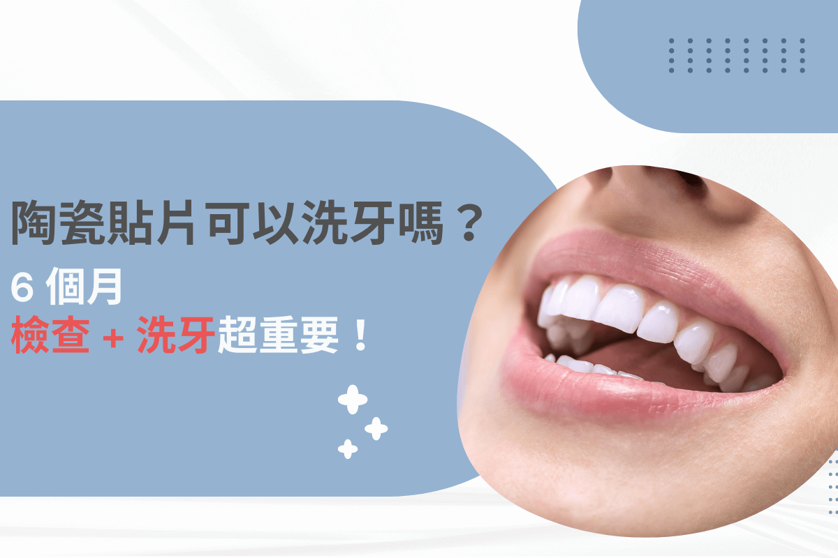 陶瓷貼片可以洗牙嗎？6個月檢查 + 洗牙超重要！