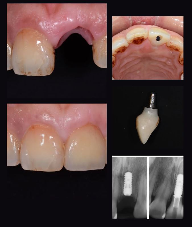 前牙植牙美學：從缺牙到自然重建的專業修復過程