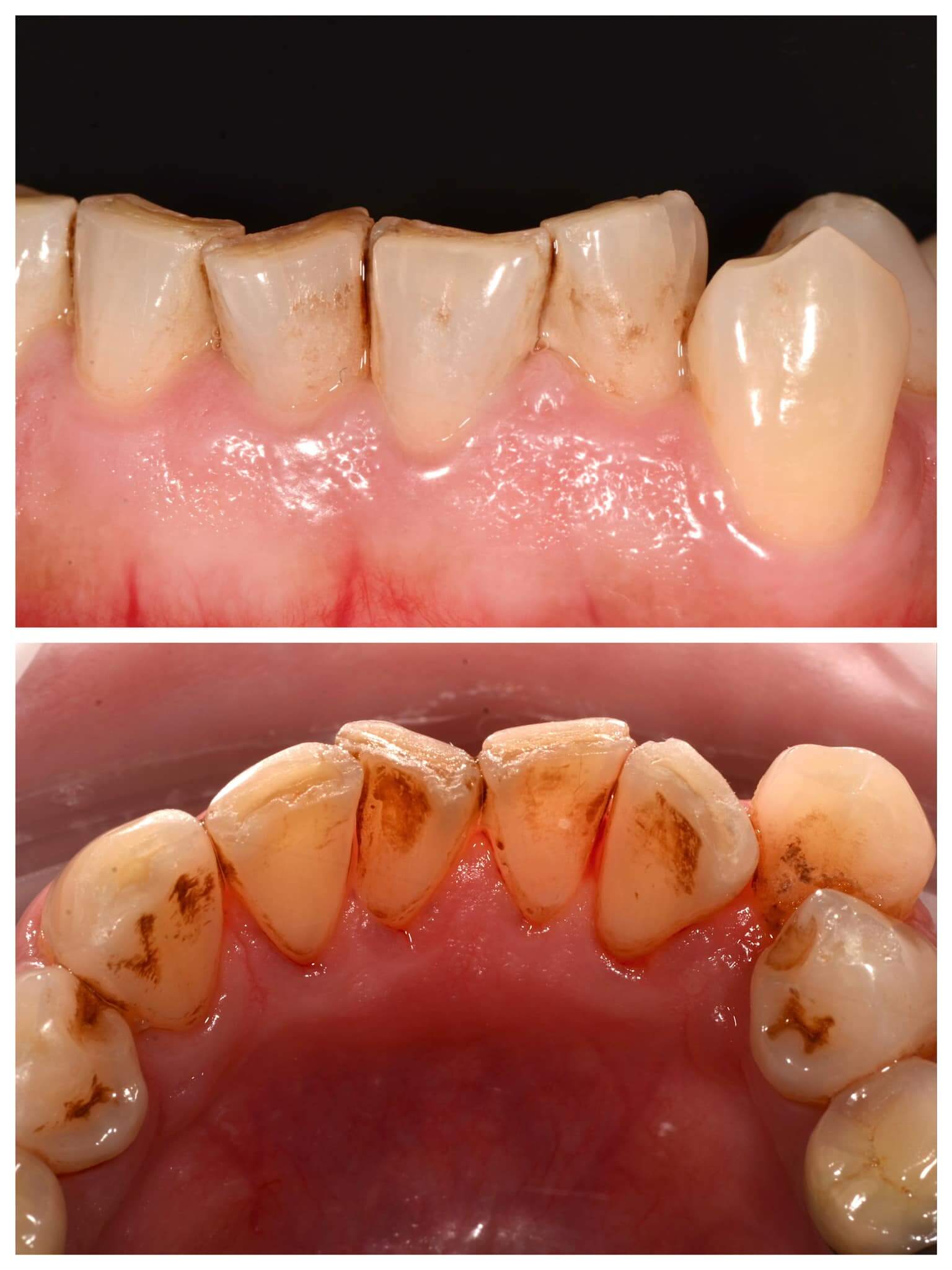 外因性牙齒染色案例:常見於飲食與生活習慣