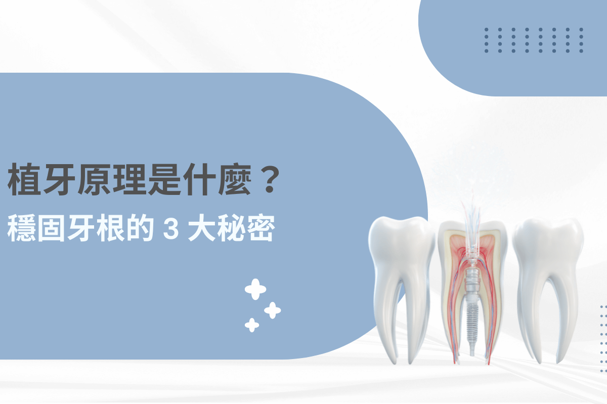 植牙原理是什麼？揭開穩固牙根的 3 大秘密