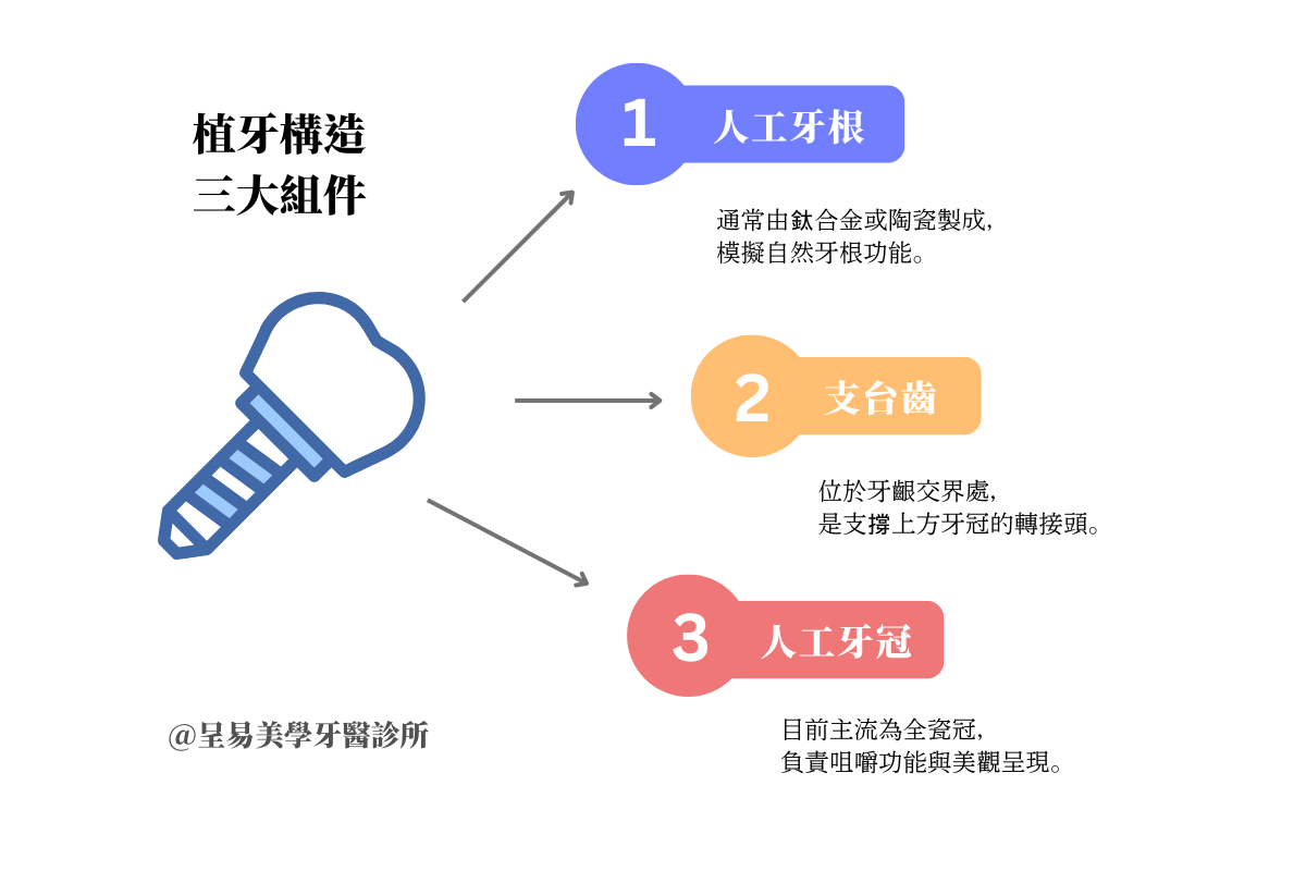 植牙構造三大組件：一次看懂人工牙根、支台齒與人工牙冠