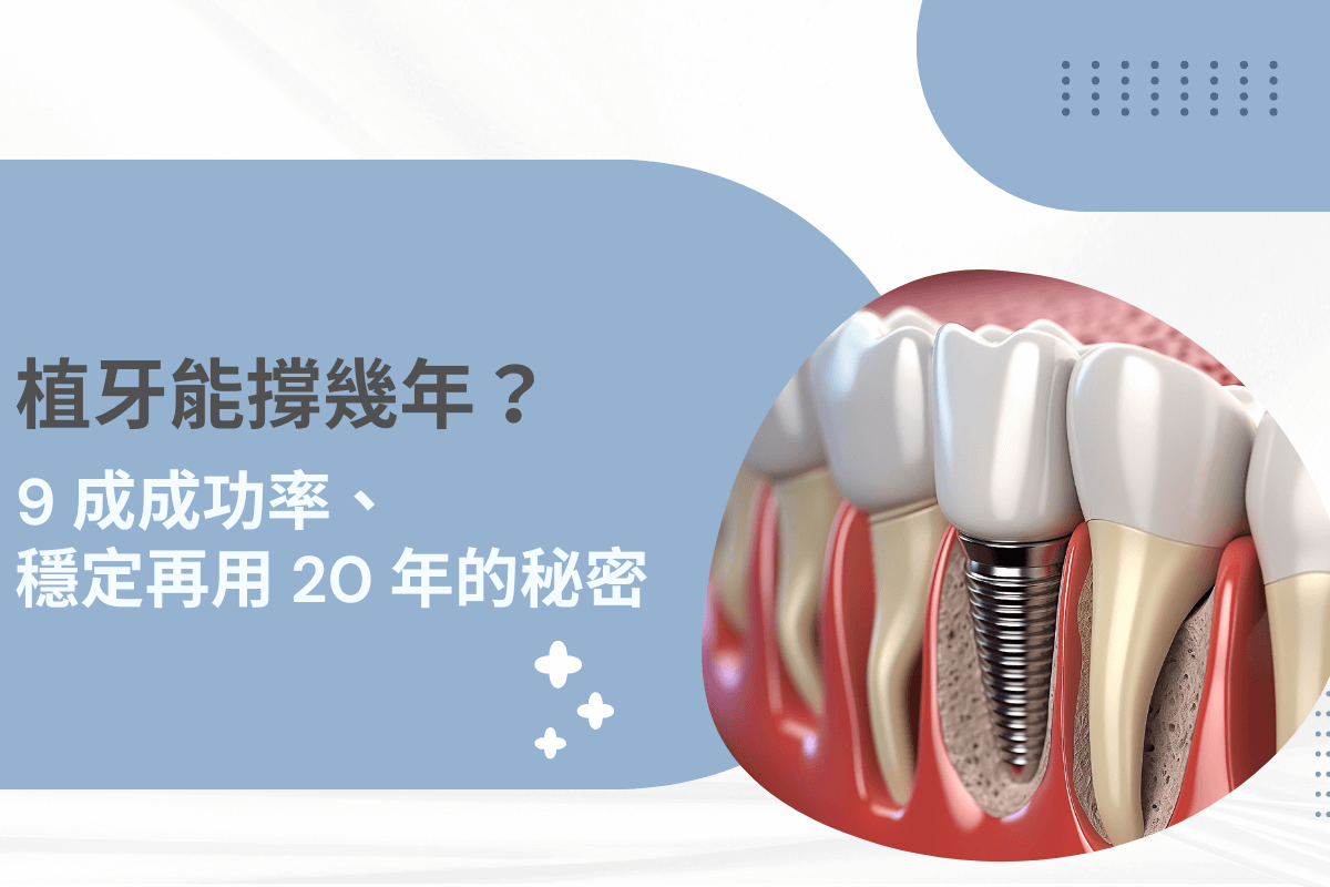 植牙能撐幾年？揭開 9 成成功率與穩定使用 20 年的秘密