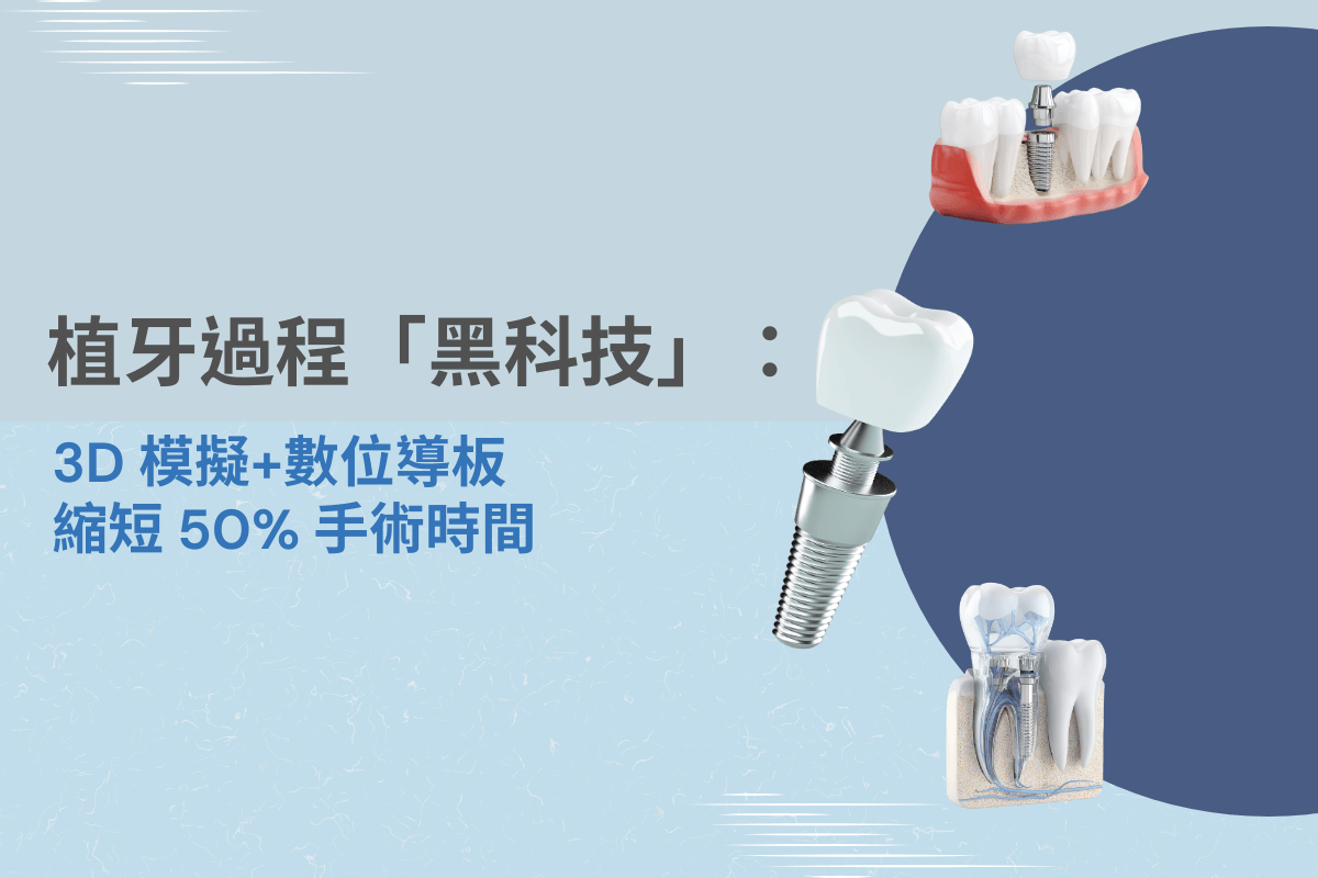 植牙過程黑科技：3D 模擬與數位導板大幅縮短手術時間