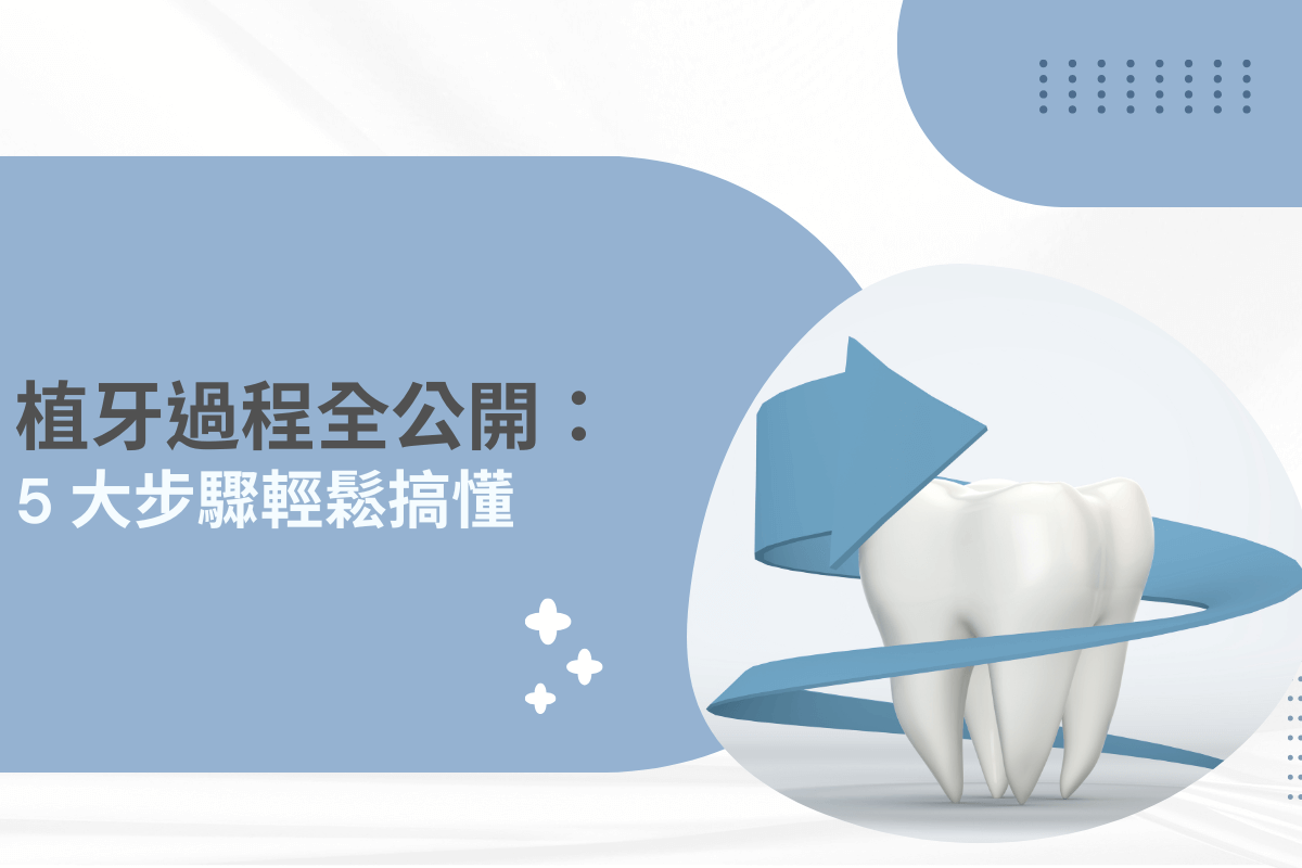 植牙過程全公開：5 大步驟輕鬆搞懂