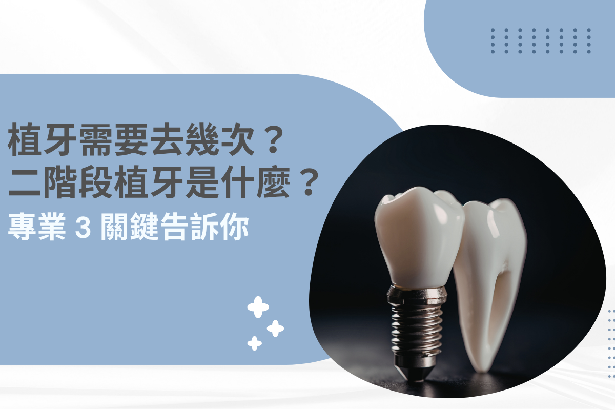 植牙需要去幾次？二階段植牙是什麼？專業 3 關鍵告訴你