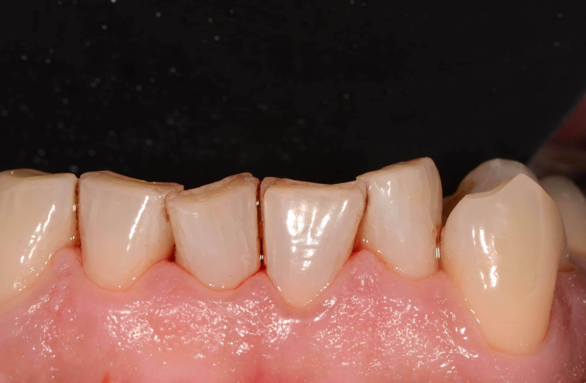 噴砂美白告別茶垢咖啡垢，還原牙齒原本色澤