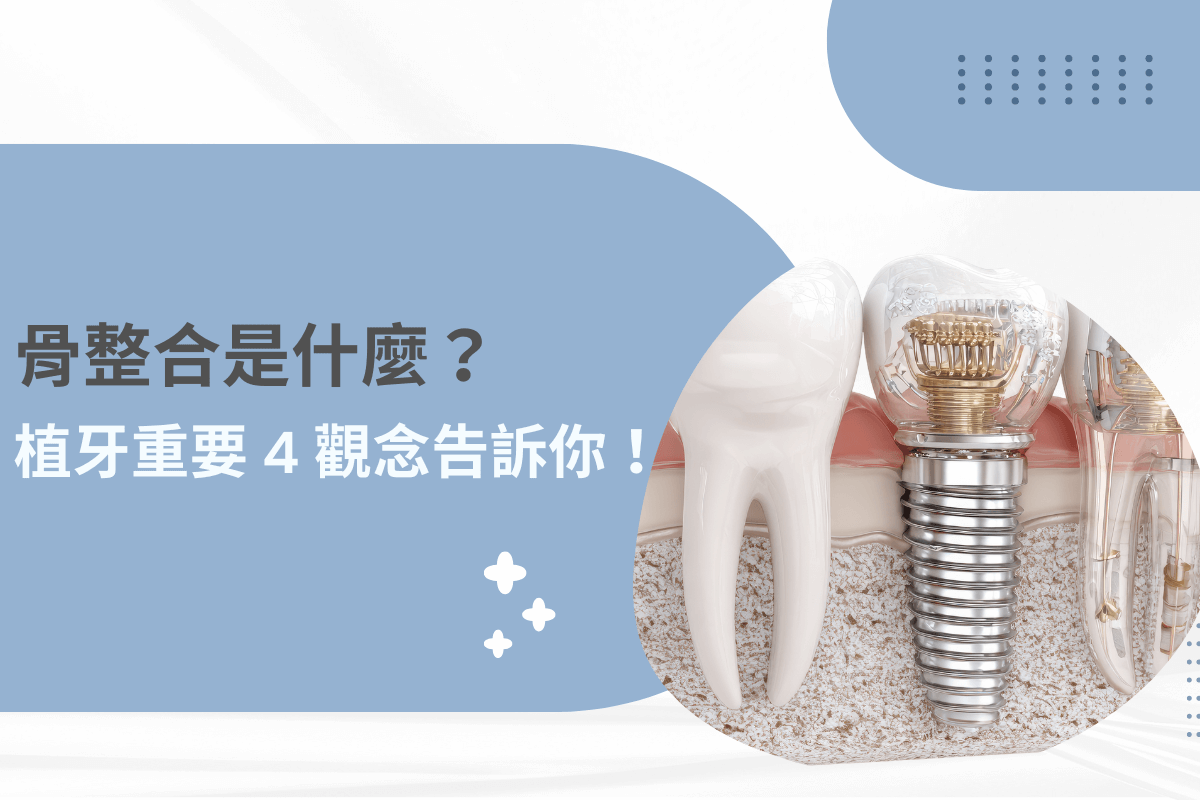 骨整合是什麼？掌握植牙成功的 4 大重要觀念