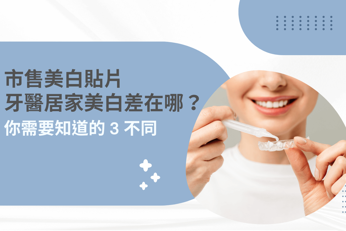 市售美白貼片、牙醫居家美白差在哪？你需要知道的 3 不同