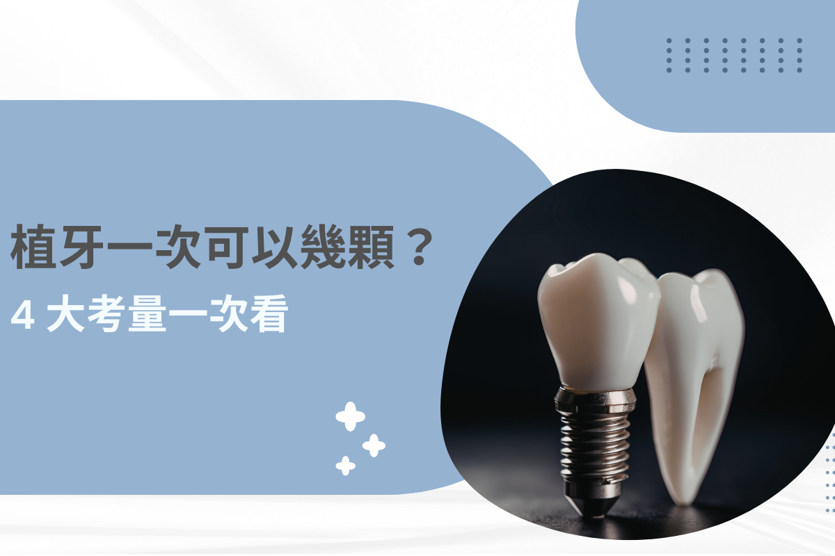 植牙一次可以幾顆？專業醫師帶你看 4 大關鍵考量