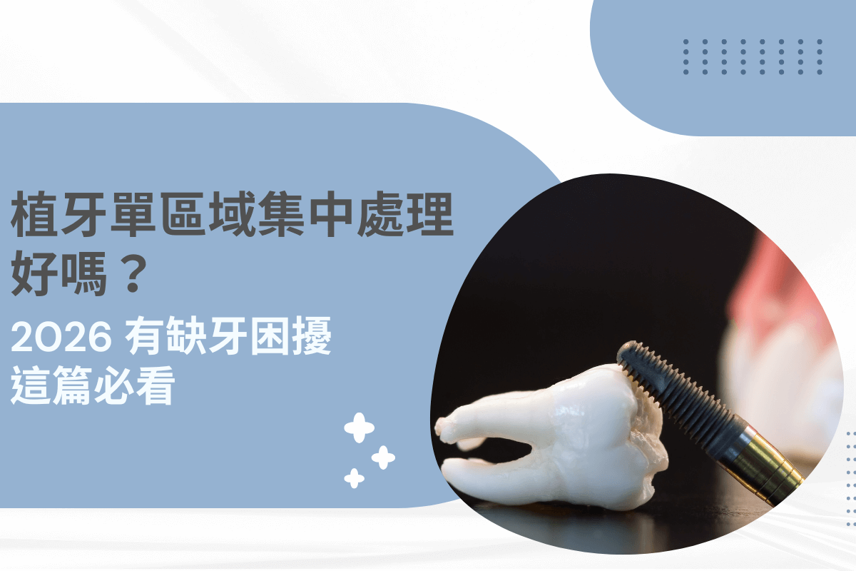 植牙單區域集中處理好嗎？2026 缺牙解決方案全解析