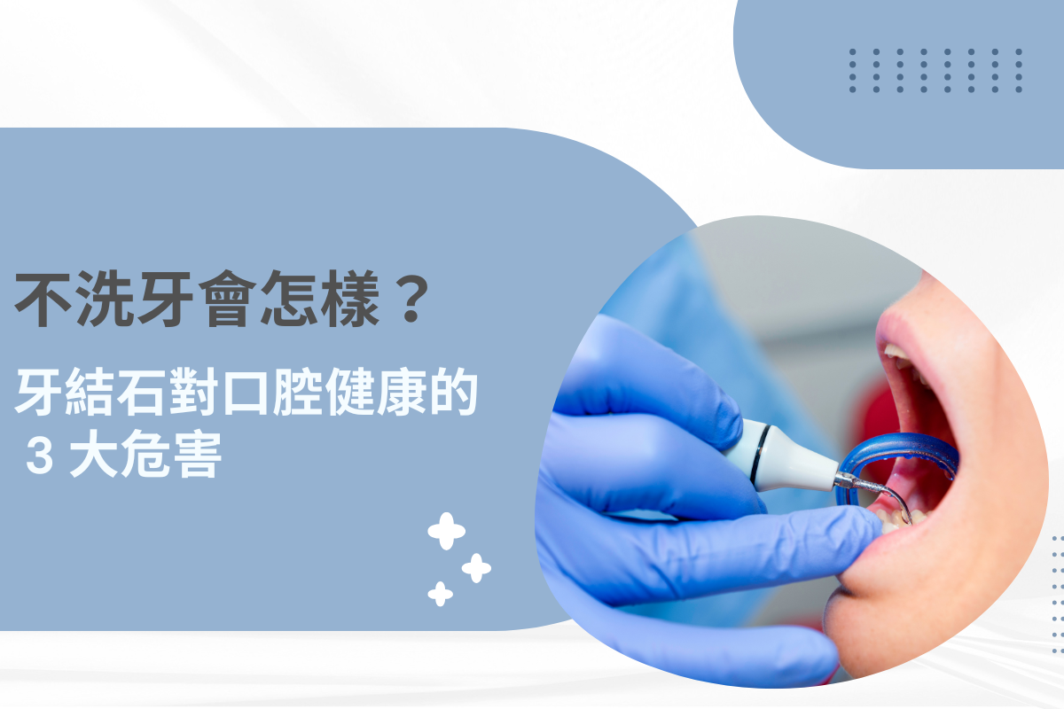 不洗牙會怎樣？牙結石對口腔健康的 3 大危害