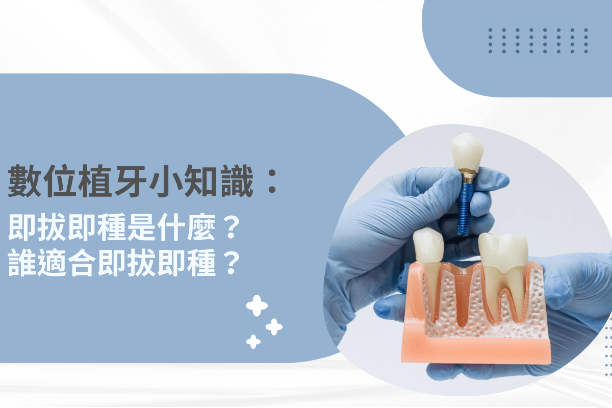 數位植牙小知識：即拔即種是什麼？誰適合即拔即種？