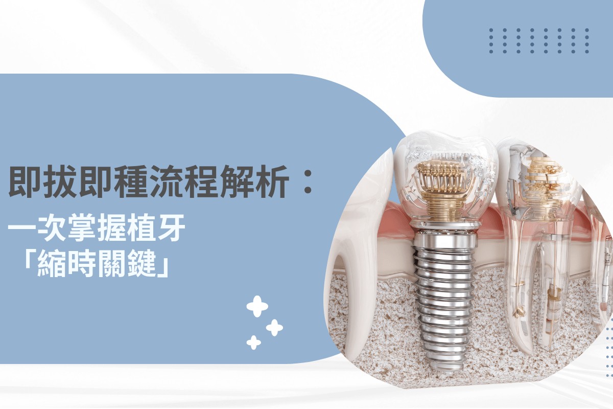 即拔即種流程解析：一次掌握植牙「縮時關鍵」