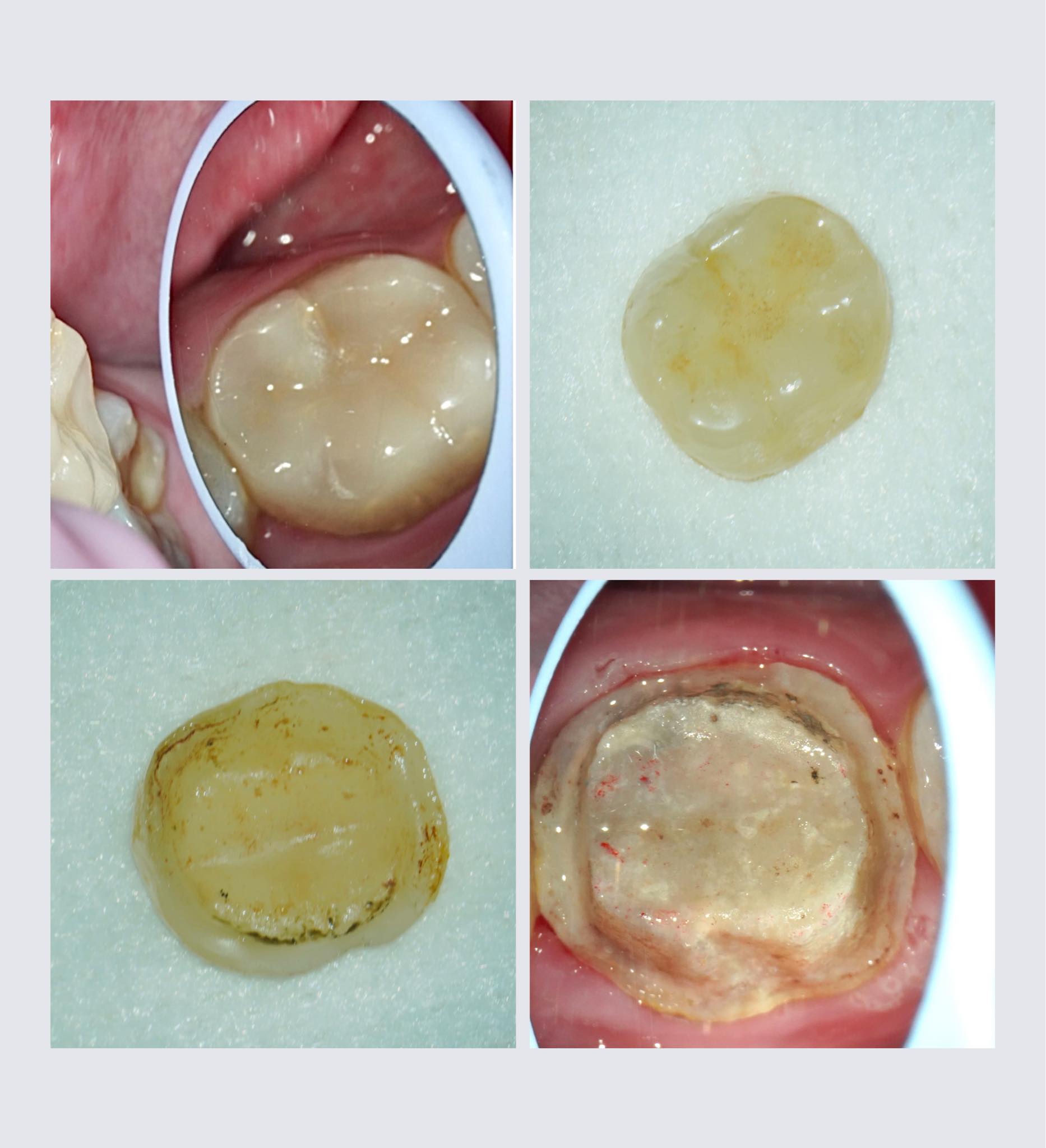 水雷射拆除假牙案例：微創精準，完整保留真牙齒質