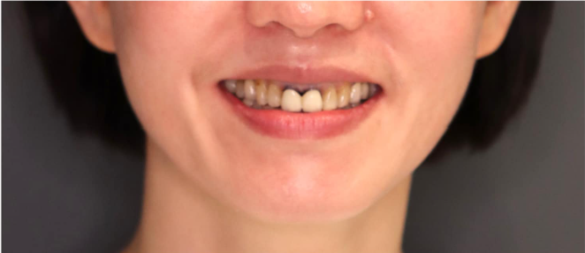 Before 牙齒矯正前