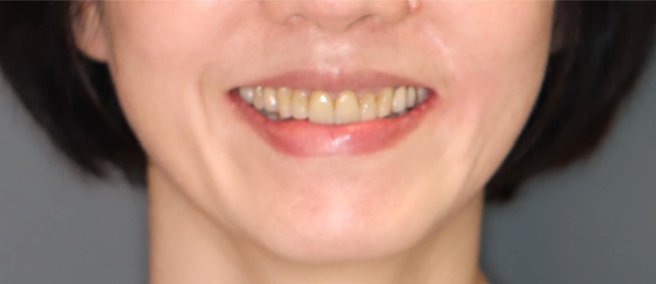 After 牙齒矯正後