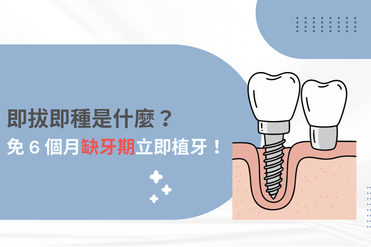 即拔即種是什麼？免除 6 個月缺牙期，當天恢復牙齒美觀